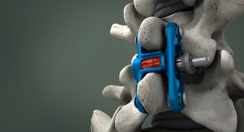 Wenzel Spine Reports 1st Cases with panaSIa SI Fusion, Begins Soft U.S. Launch